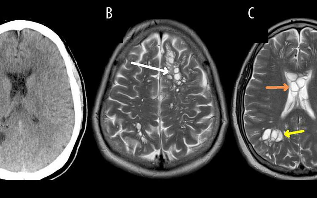 Amerikaan schrikt zich rot: geen migraine, maar lintworm in hoofd